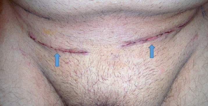 双侧开放性腹股沟疝修补术(蓝色箭头指着手术伤口)