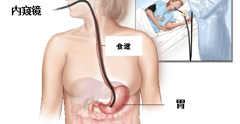 胃镜/内窥镜（Upper GI Endoscopy/OGDS）